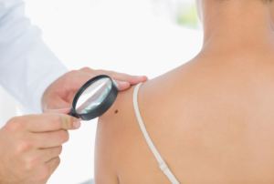 prevenzione del melanoma